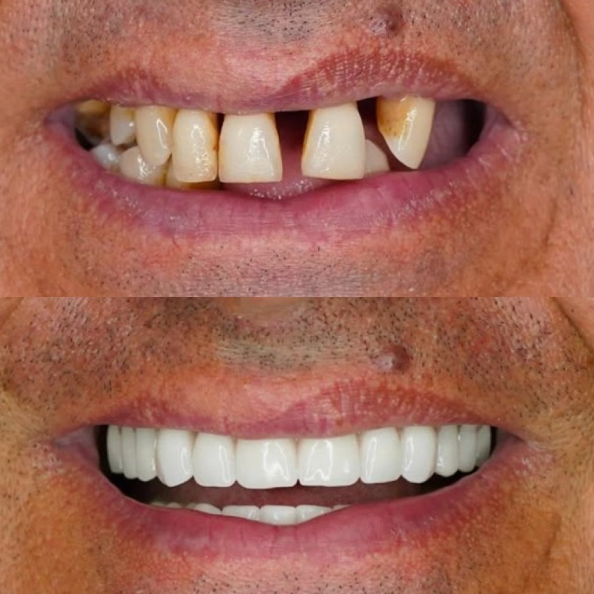 Результат до та після імплантації All-on-4 у Shtern Dental Clinic, відновлення усмішки