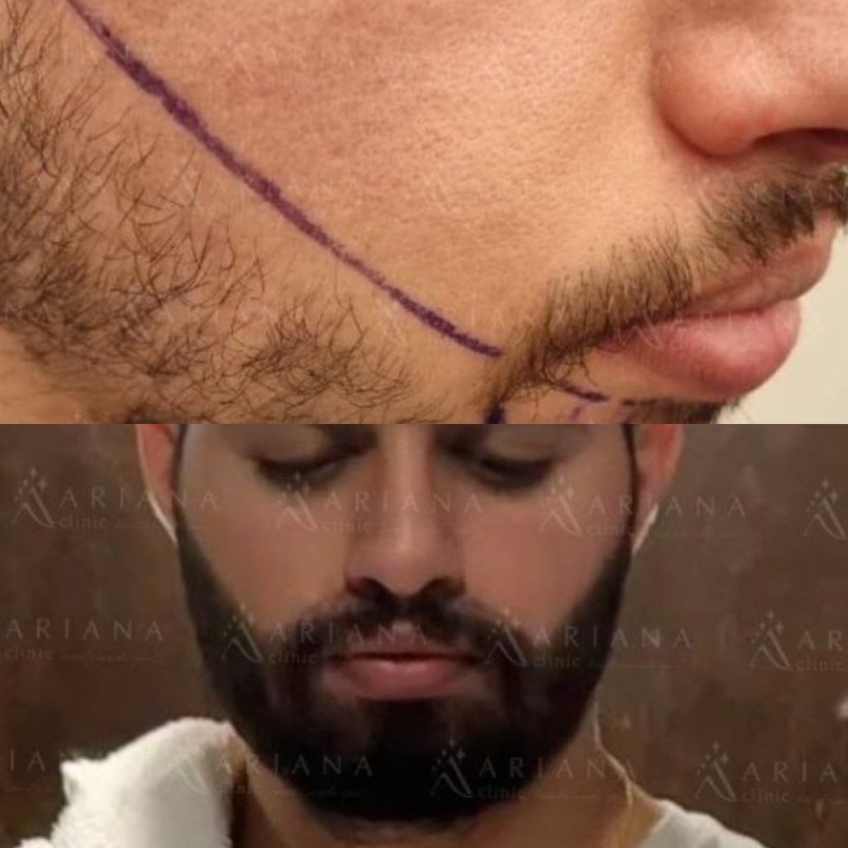 نتائج زراعة اللحية قبل وبعد في عيادة أريانا – لحية أكثر كثافة وطبيعية