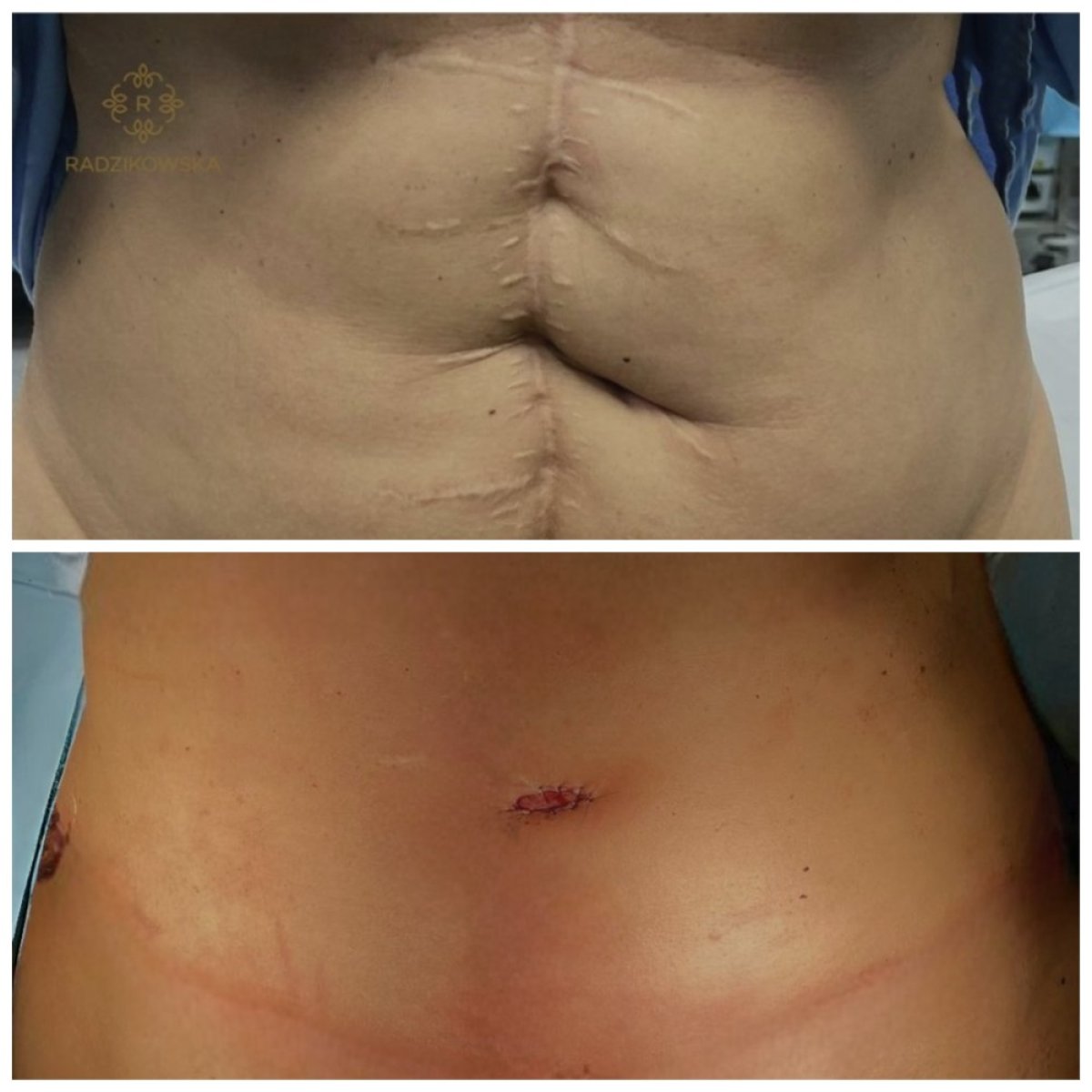 Before and after tummy tuck and liposuction results at Radzikowska Clinic, flatter abdomen