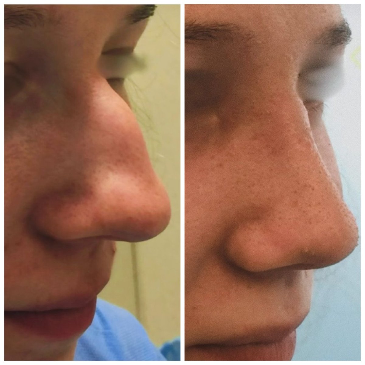 Before and after rhinoplasty results at Radzikowska Clinic, nose reshaping improvement