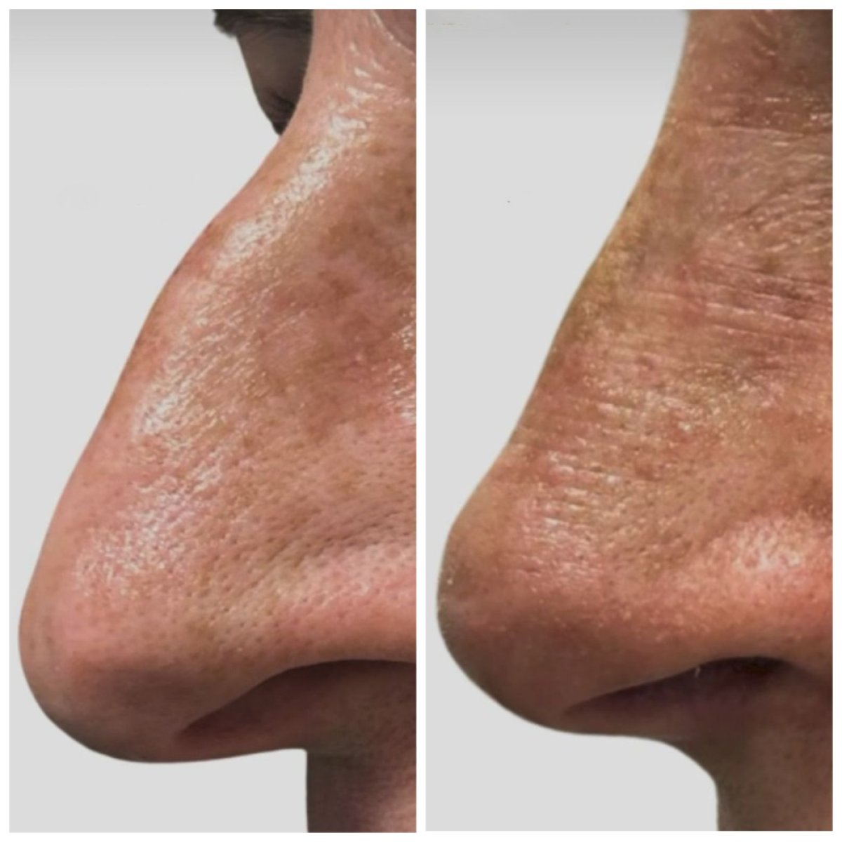 Before and after rhinoplasty result at Radzikowska Clinic, improved nose shape and contour
