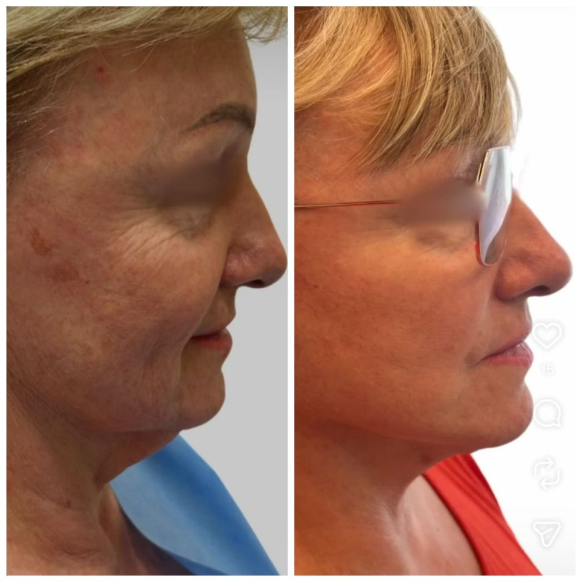 Efekty przed i po deep plane facelift w Radzikowska Clinic, odmłodzenie twarzy
