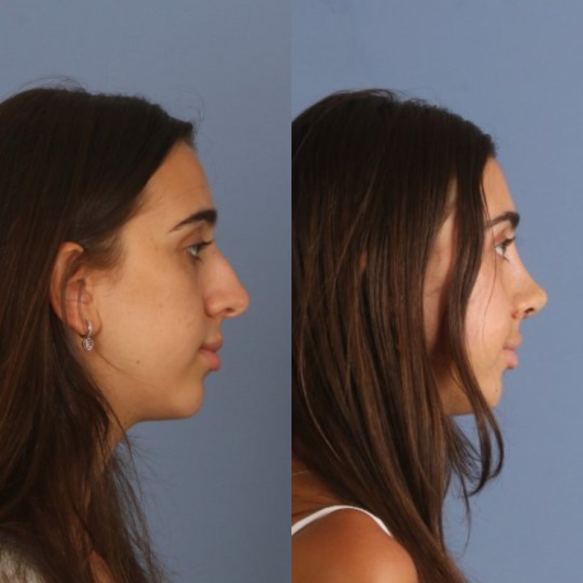 نتائج عملية تجميل الأنف قبل وبعد، إعادة تشكيل الأنف لتحسين المظهر والتناغم