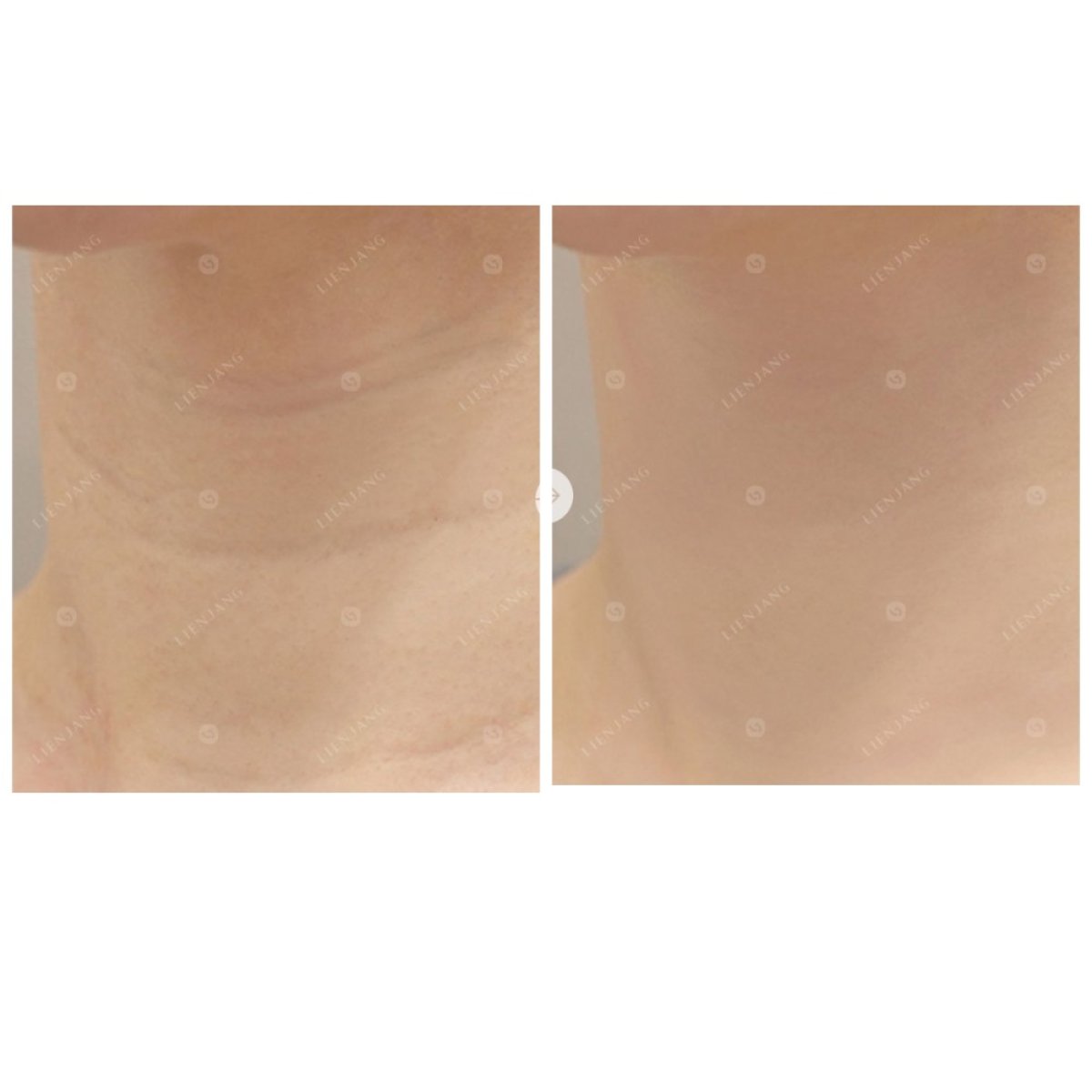 Avant-après Botox pour rides du cou à la clinique, résultat peau lissée visible