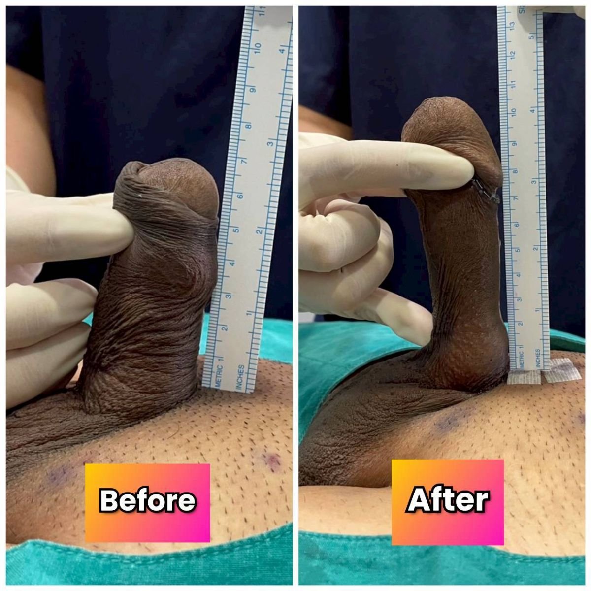 Résultats avant et après allongement pénien chirurgical à Eternity Clinic Phuket By Dr.Beer