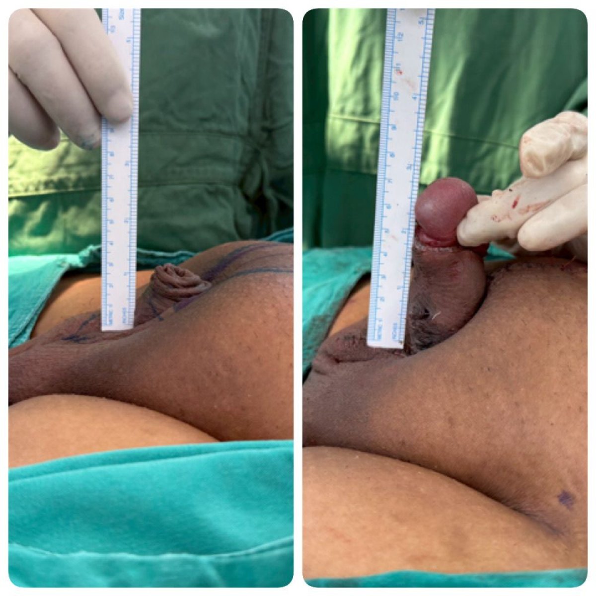 Before and after surgical penile lengthening results at Eternity Clinic Phuket By Dr.Beer