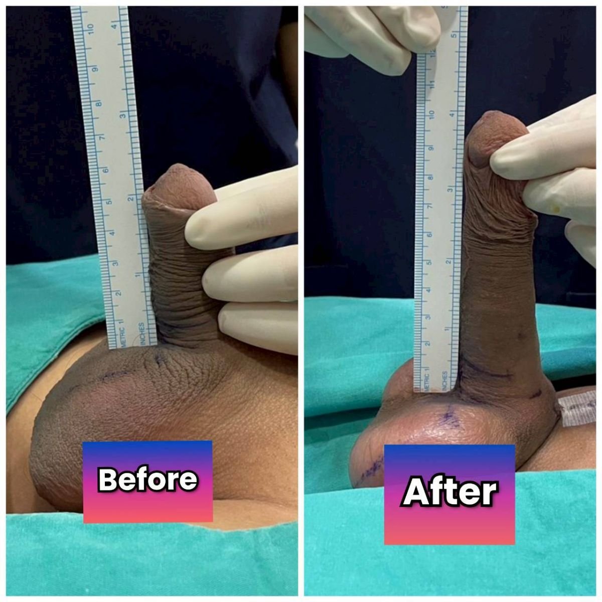 نتائج قبل وبعد إطالة القضيب الجراحية في Eternity Clinic Phuket By Dr.Beer