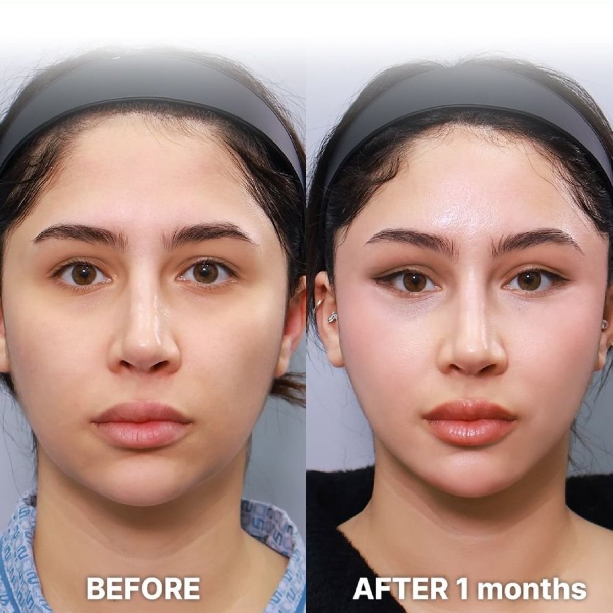Before and after blepharoplasty results at Returning Plastic Surgery, eyelid correction outcome