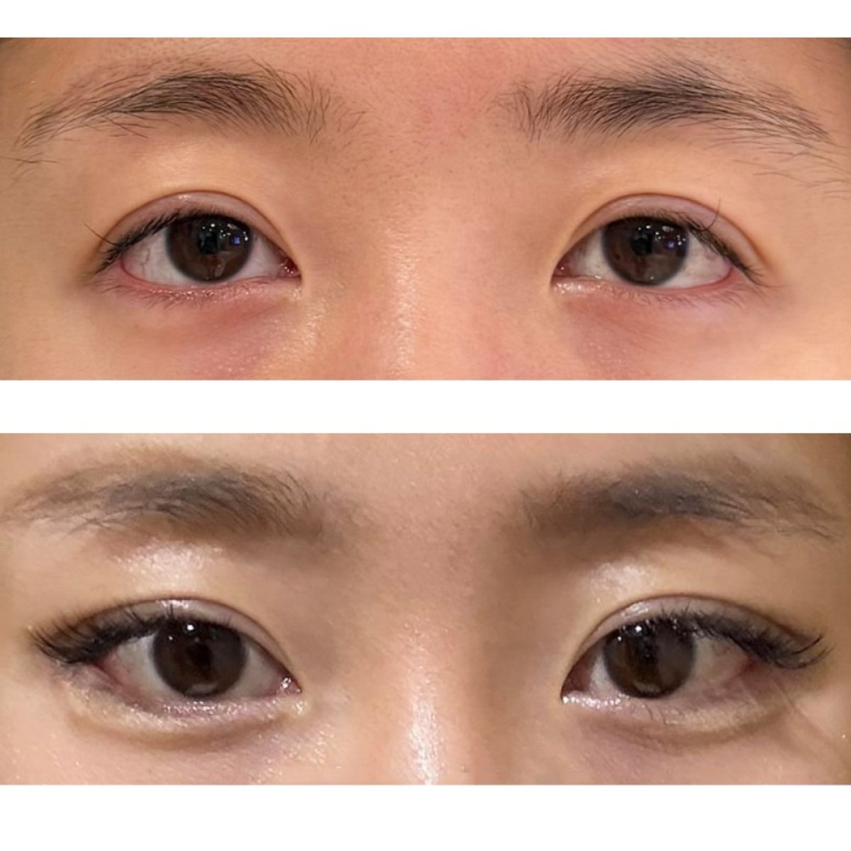 Before and after blepharoplasty results at Returning Plastic Surgery, eyelid correction outcome