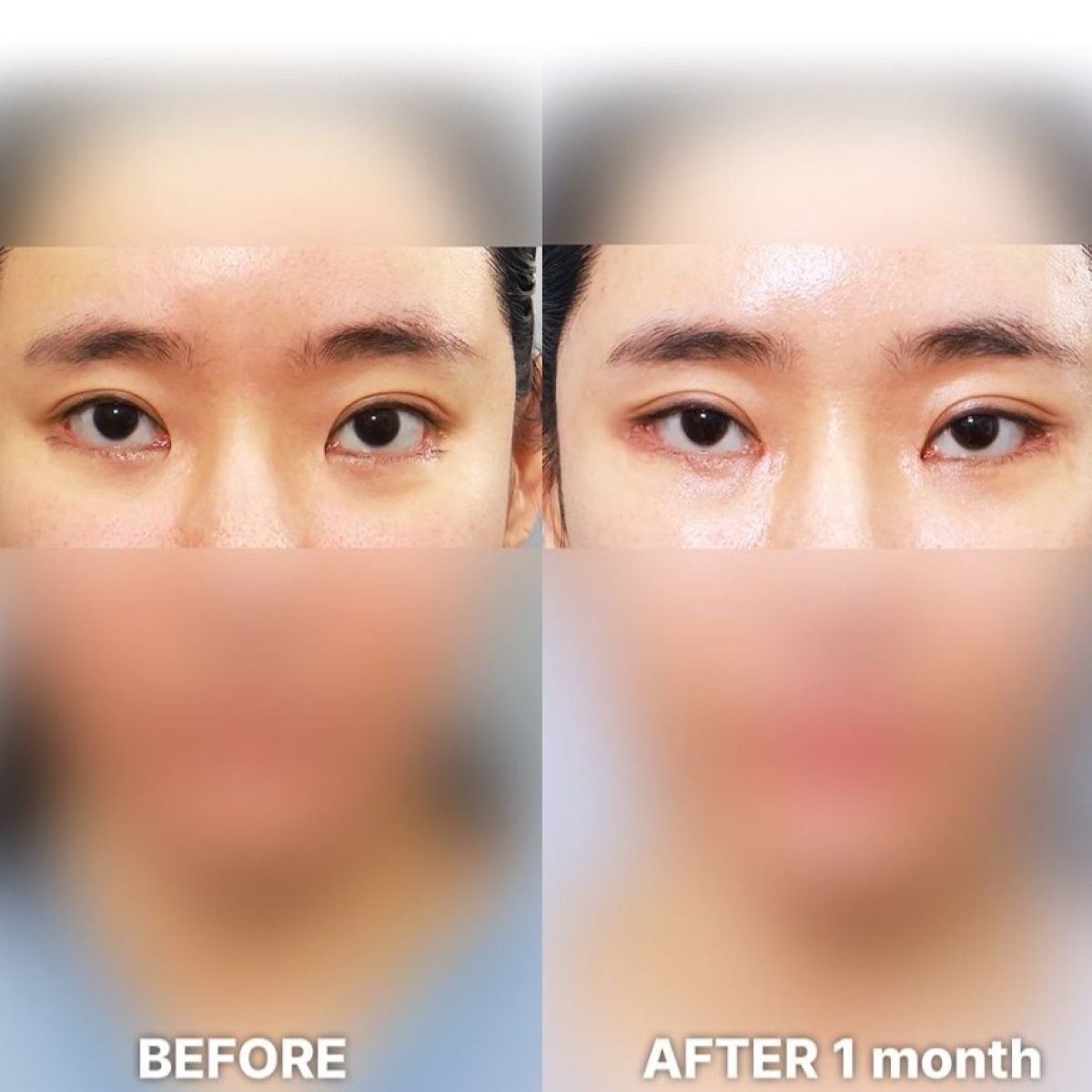 Before and after blepharoplasty results at Returning Plastic Surgery, eyelid correction outcome