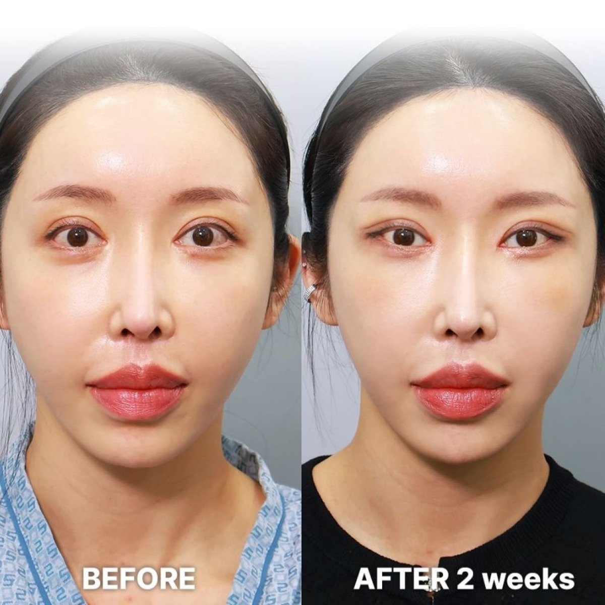 Blepharoplasty before and after results at Returning Plastic Surgery, 2 weeks post eyelid correction