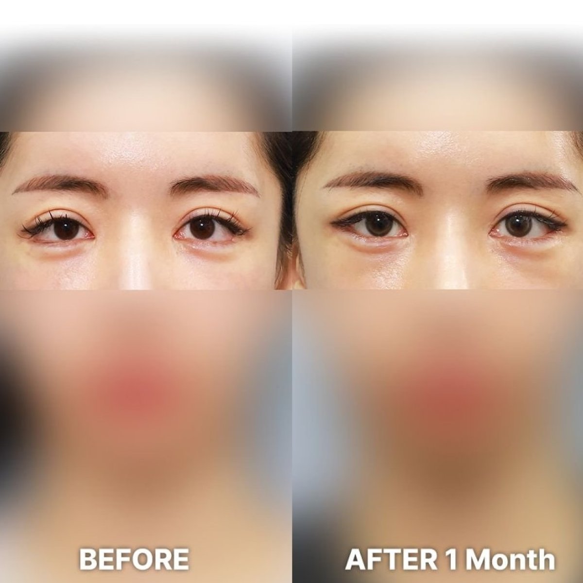 Blepharoplasty before and after results at Returning Plastic Surgery, eyelid correction outcome