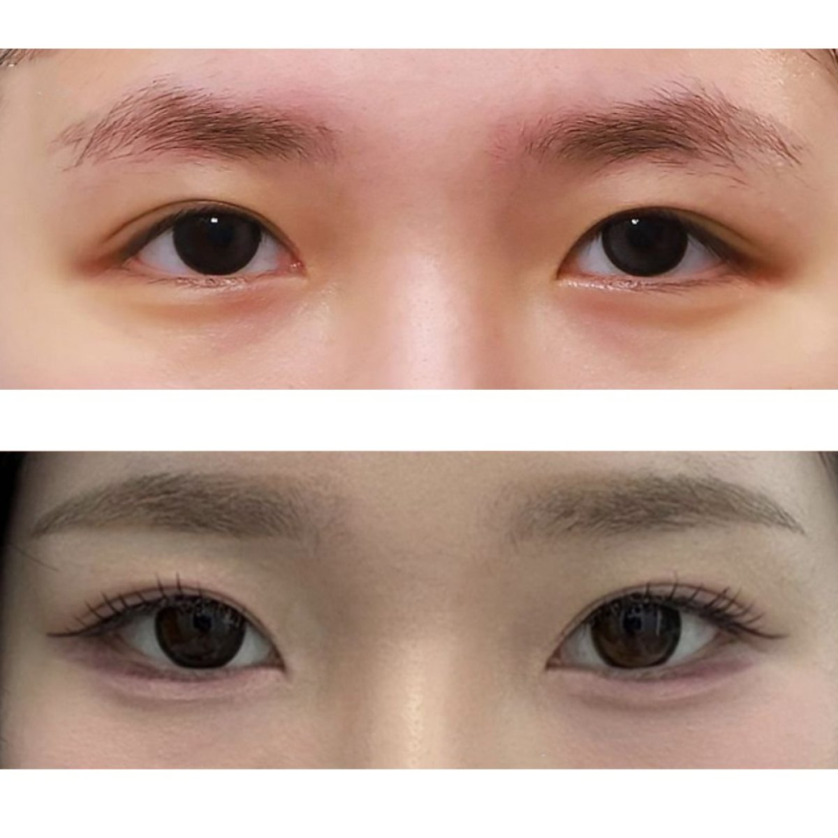 Before and after blepharoplasty results at Returning Plastic Surgery, eyelid correction outcome