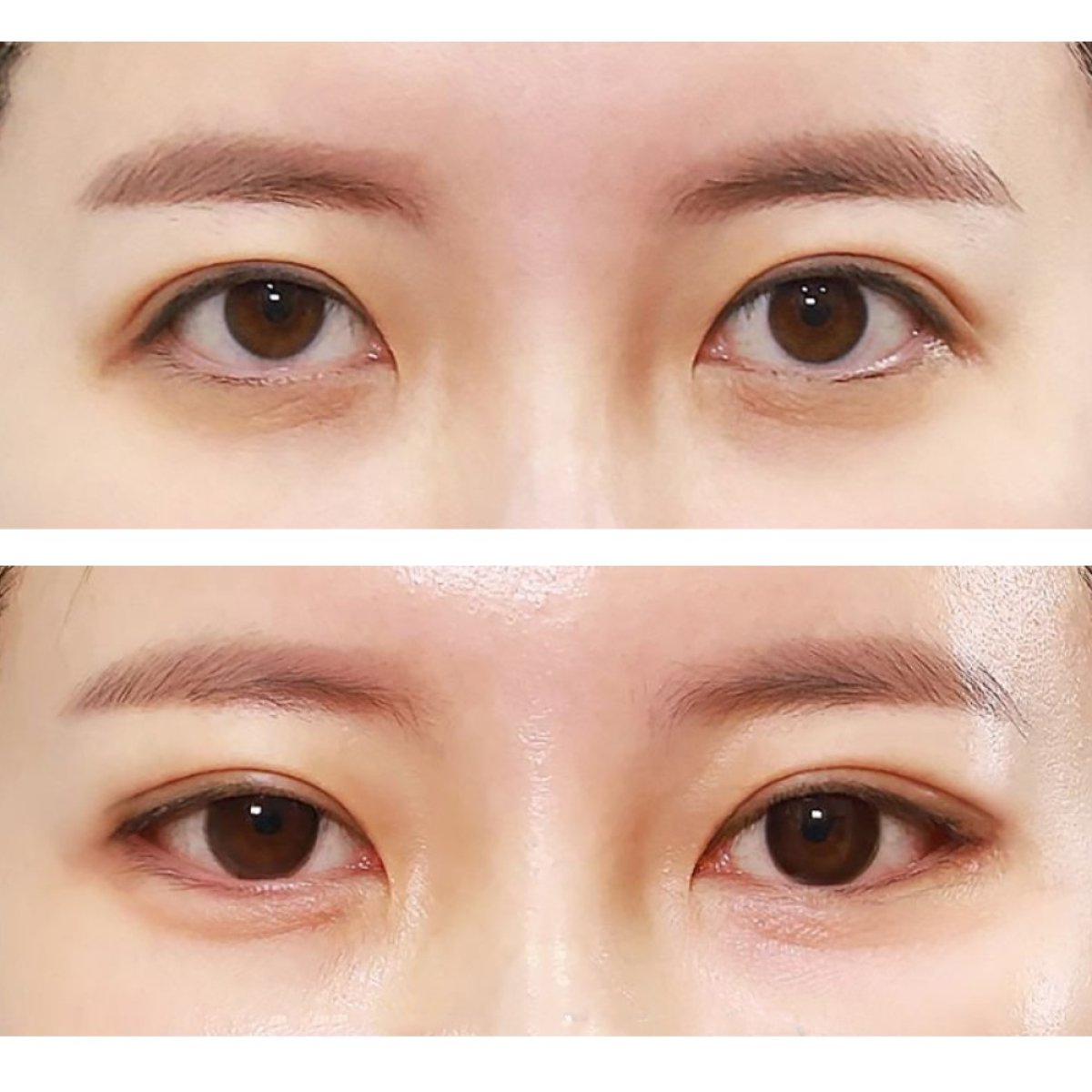 Before and after blepharoplasty results at Returning Plastic Surgery, eyelid correction improvement