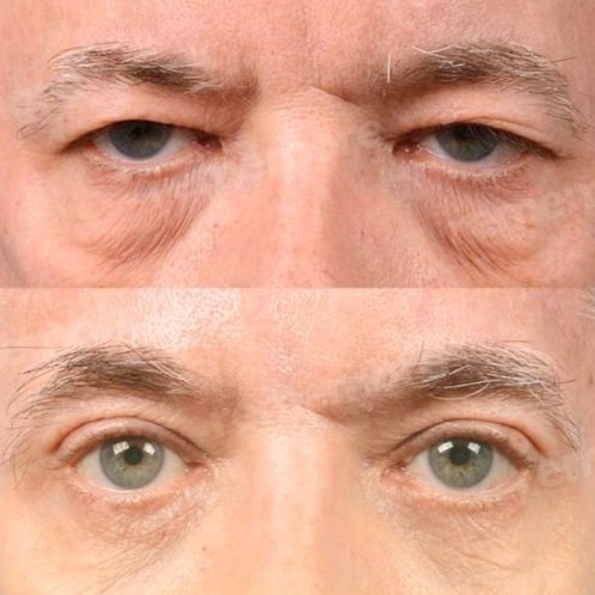 Before and after upper and lower eyelid surgery results at Memorial Göztepe Hospital