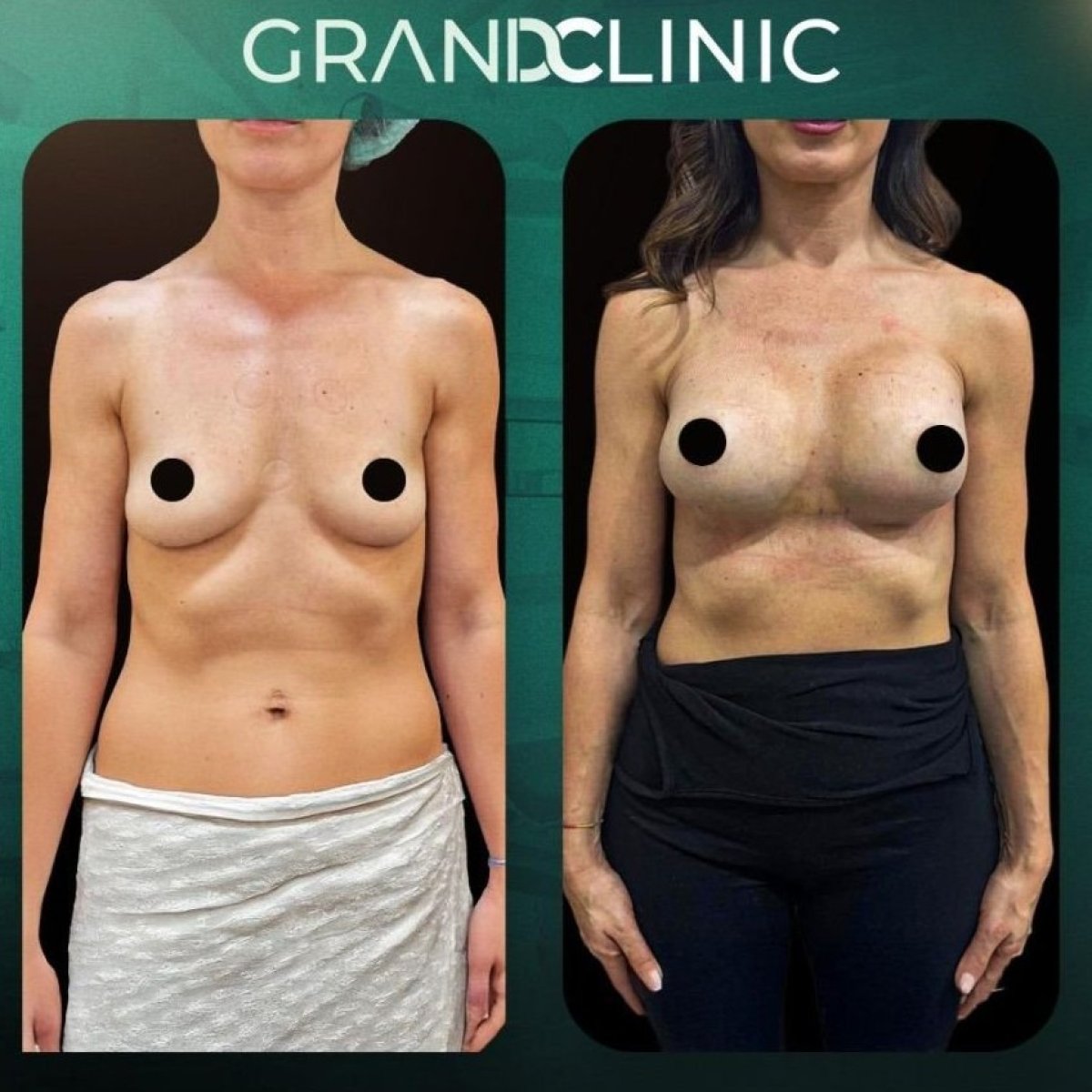 Résultats avant/après augmentation mammaire à Grand Clinic – forme et taille améliorées