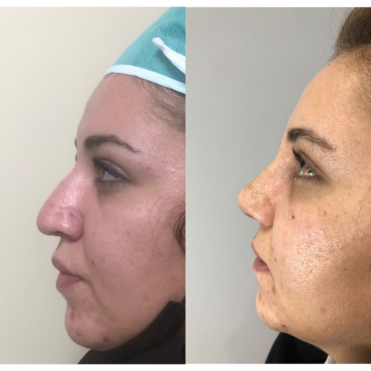 نتائج تجميل الأنف قبل وبعد، إعادة تشكيل الأنف وتحسين المظهر الجانبي