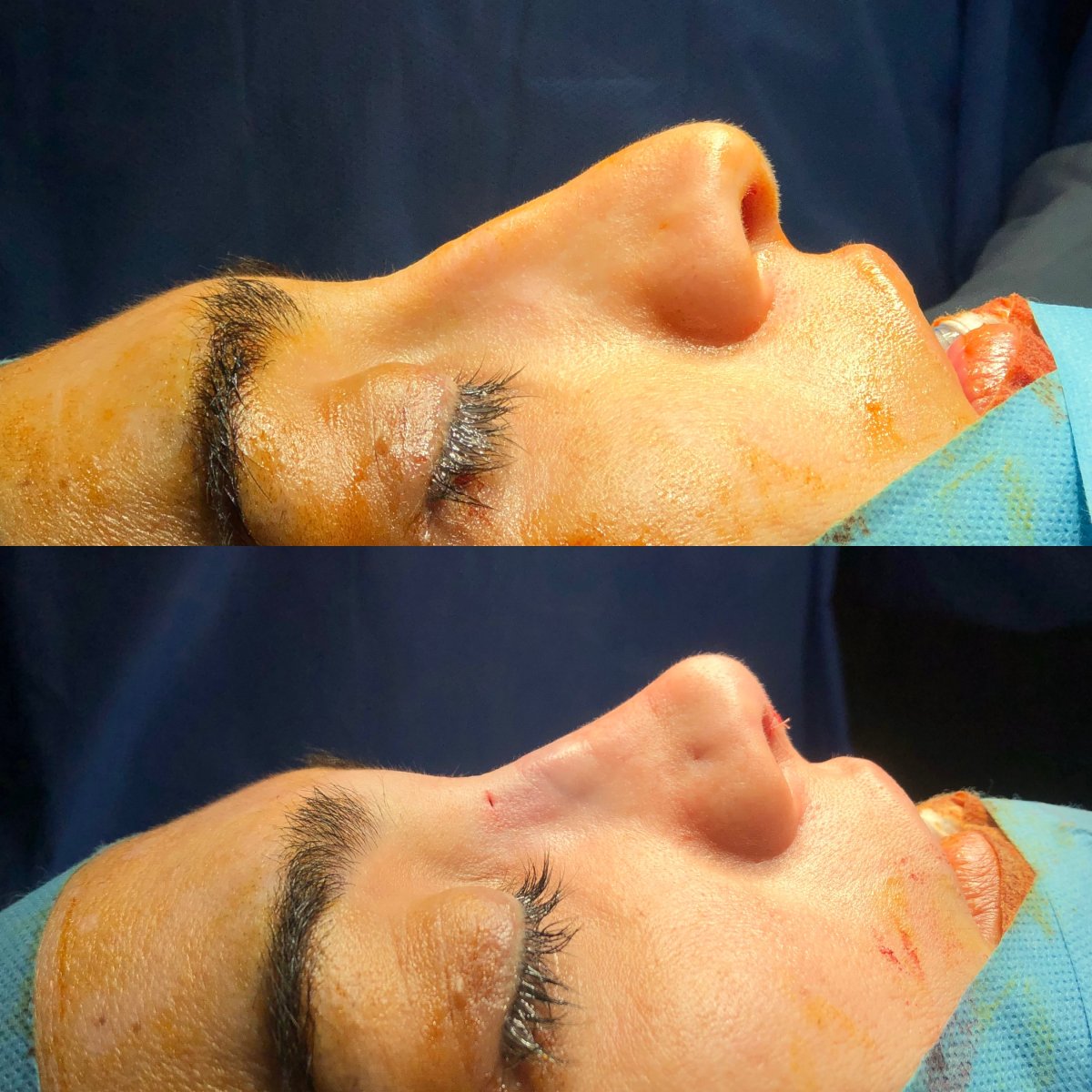 نتائج تجميل الأنف قبل وبعد، إعادة تشكيل الأنف وتحسين المظهر الجانبي