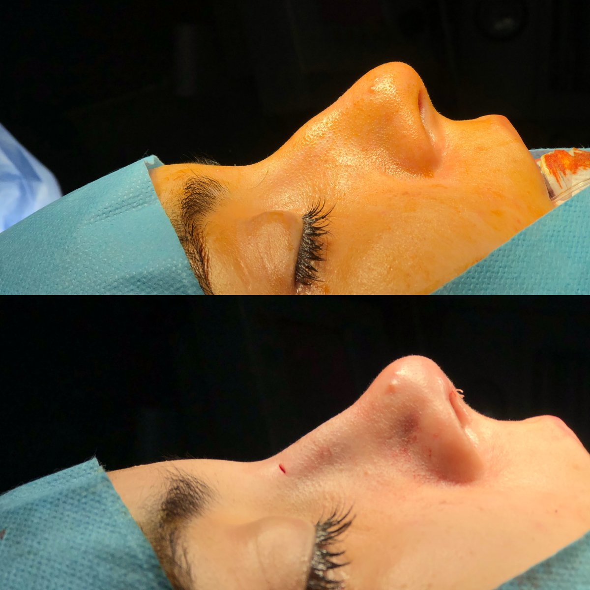 Before and after rhinoplasty results – nose reshaping with improved nasal profile