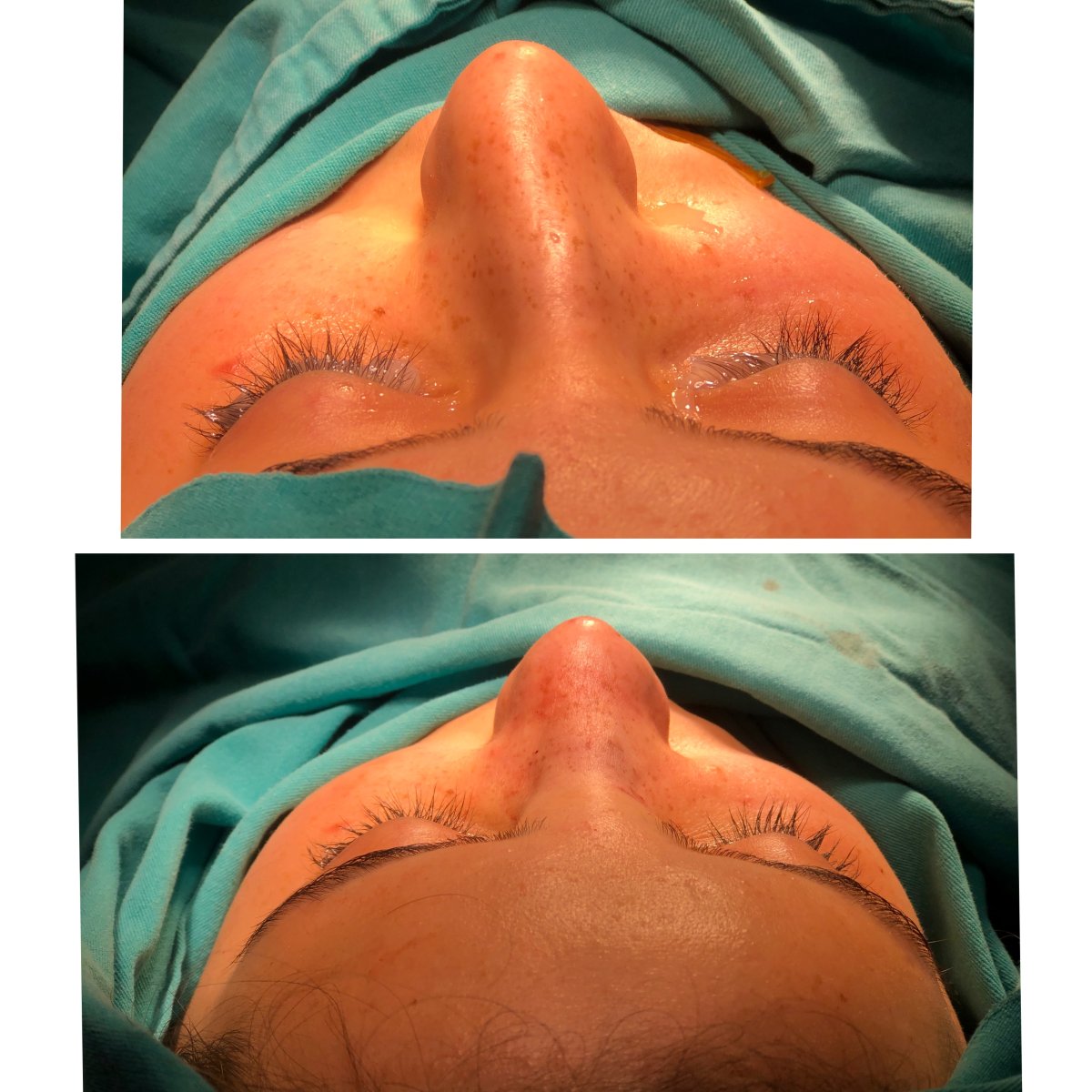 نتائج عملية تجميل الأنف قبل وبعد، تحسين شكل وتناسق الأنف