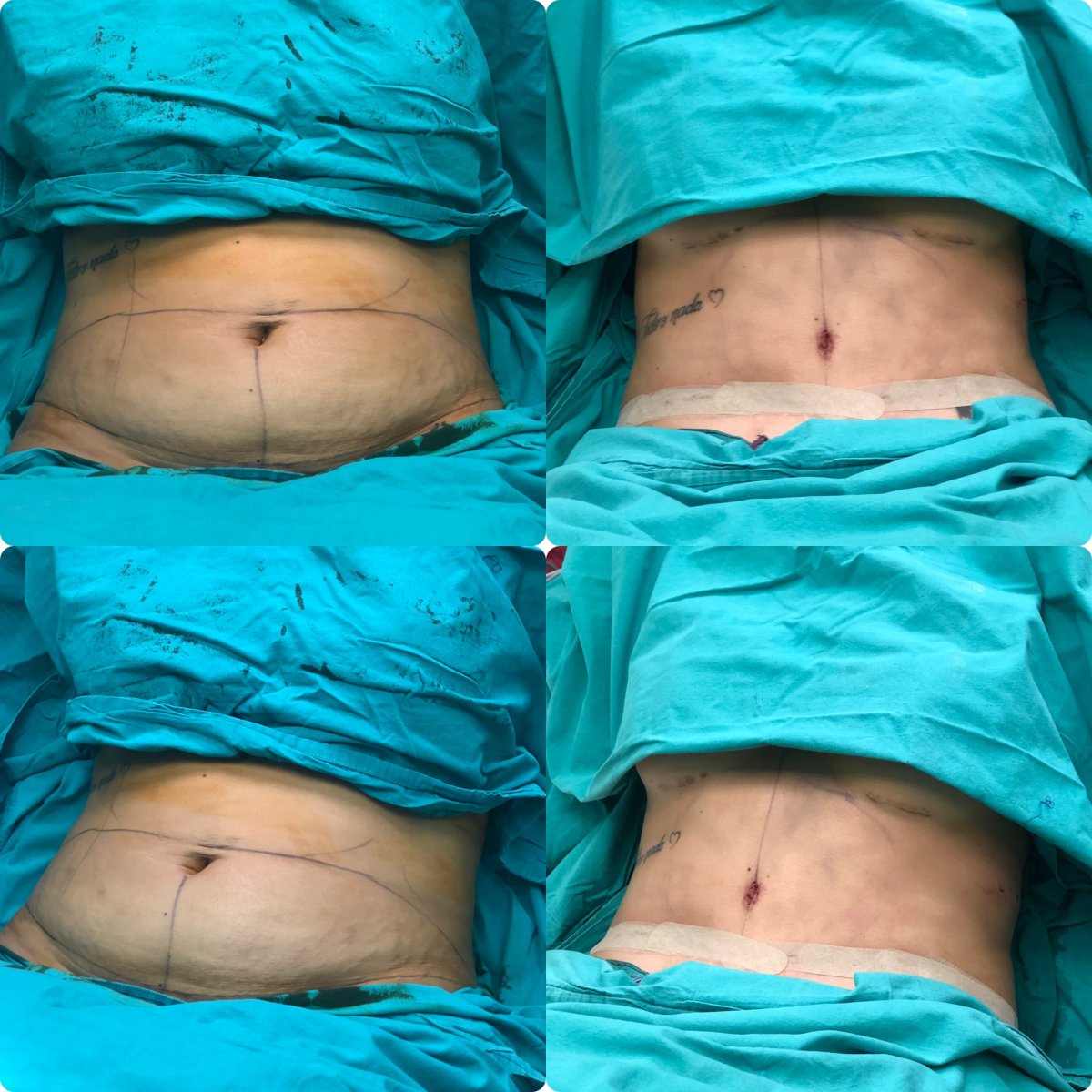 Before and after tummy tuck results – flatter abdomen and improved contour after abdominoplasty