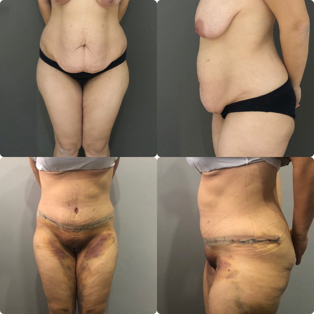 Before and after tummy tuck results – visible abdominal contour improvement after surgery