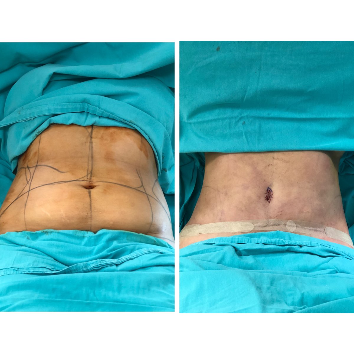Before and after tummy tuck results – flatter abdomen and improved contour after surgery