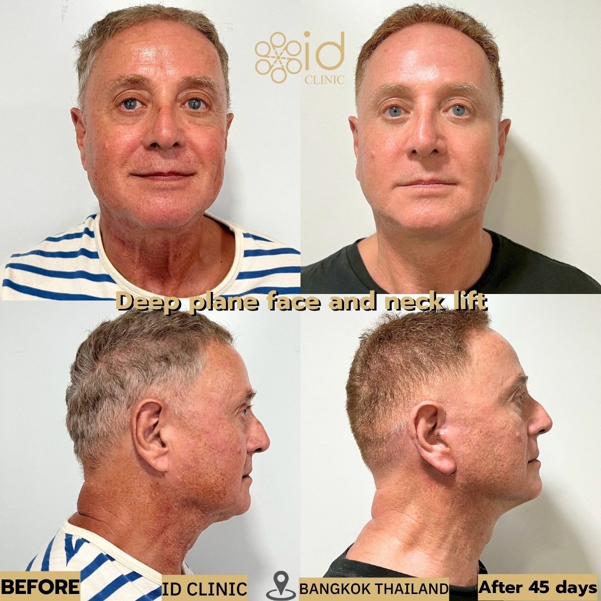 Before and after deep plane facelift and neck lift results at ID Clinic Bangkok, 45 days post-op