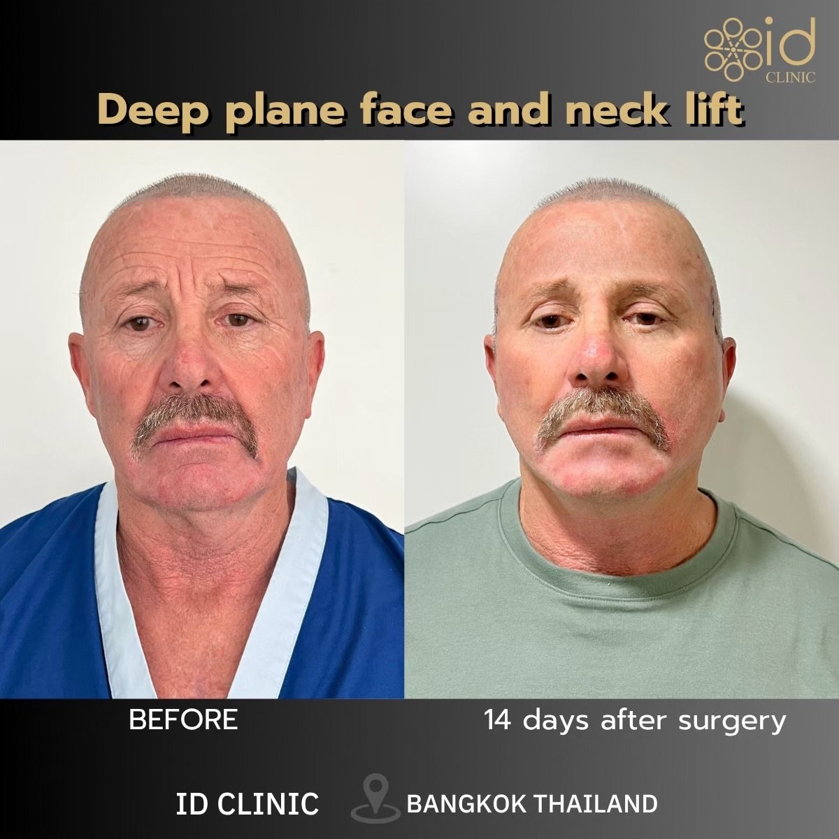 Before and after deep plane facelift and neck lift results at ID Clinic Bangkok