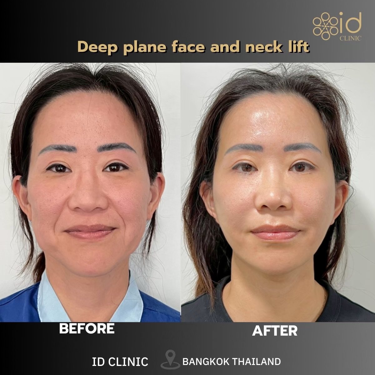 Before and after deep plane facelift and neck lift results at ID Clinic Bangkok