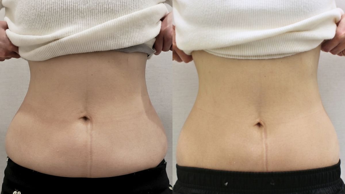 Before and after liquid liposuction at Forena Clinic – visible waist contouring result