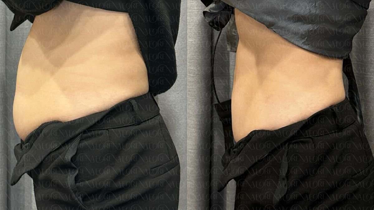 Before and after liquid liposuction at Forena Clinic – visible abdominal contouring result