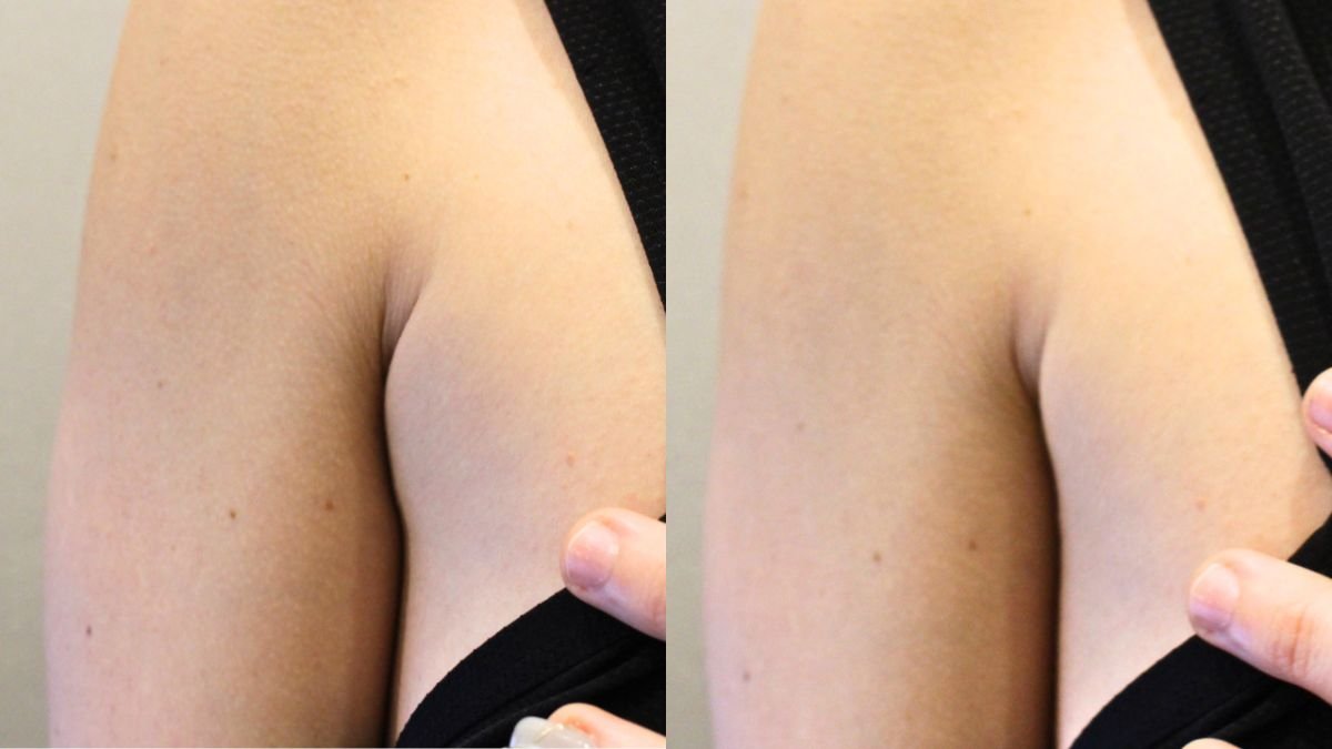 Before and after liquid liposuction arm contouring results at Forena Clinic