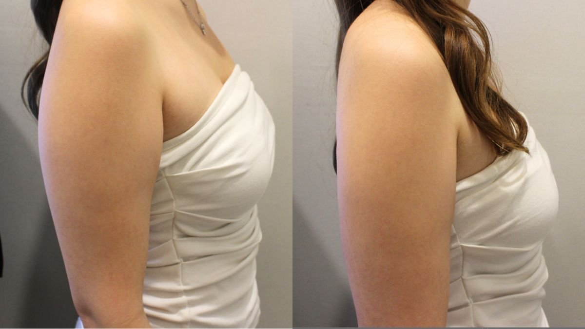 Resultados antes y después de liposucción líquida en brazos en Forena Clinic