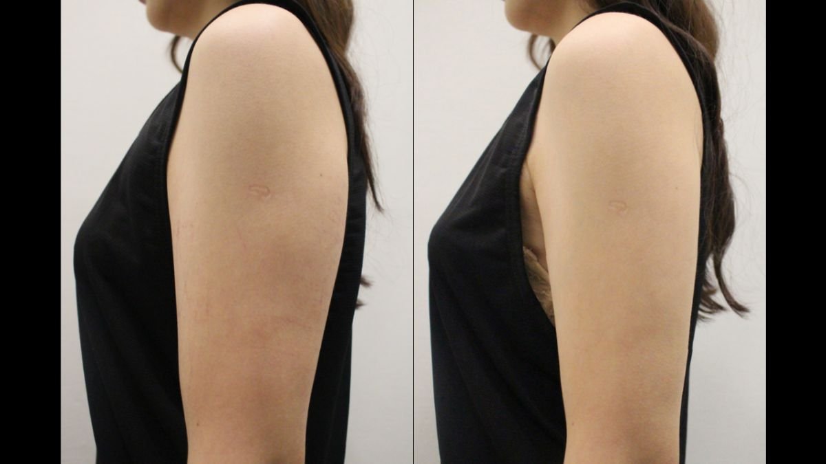 Before and after liquid liposuction result on arms at Forena Clinic, visible contour improvement