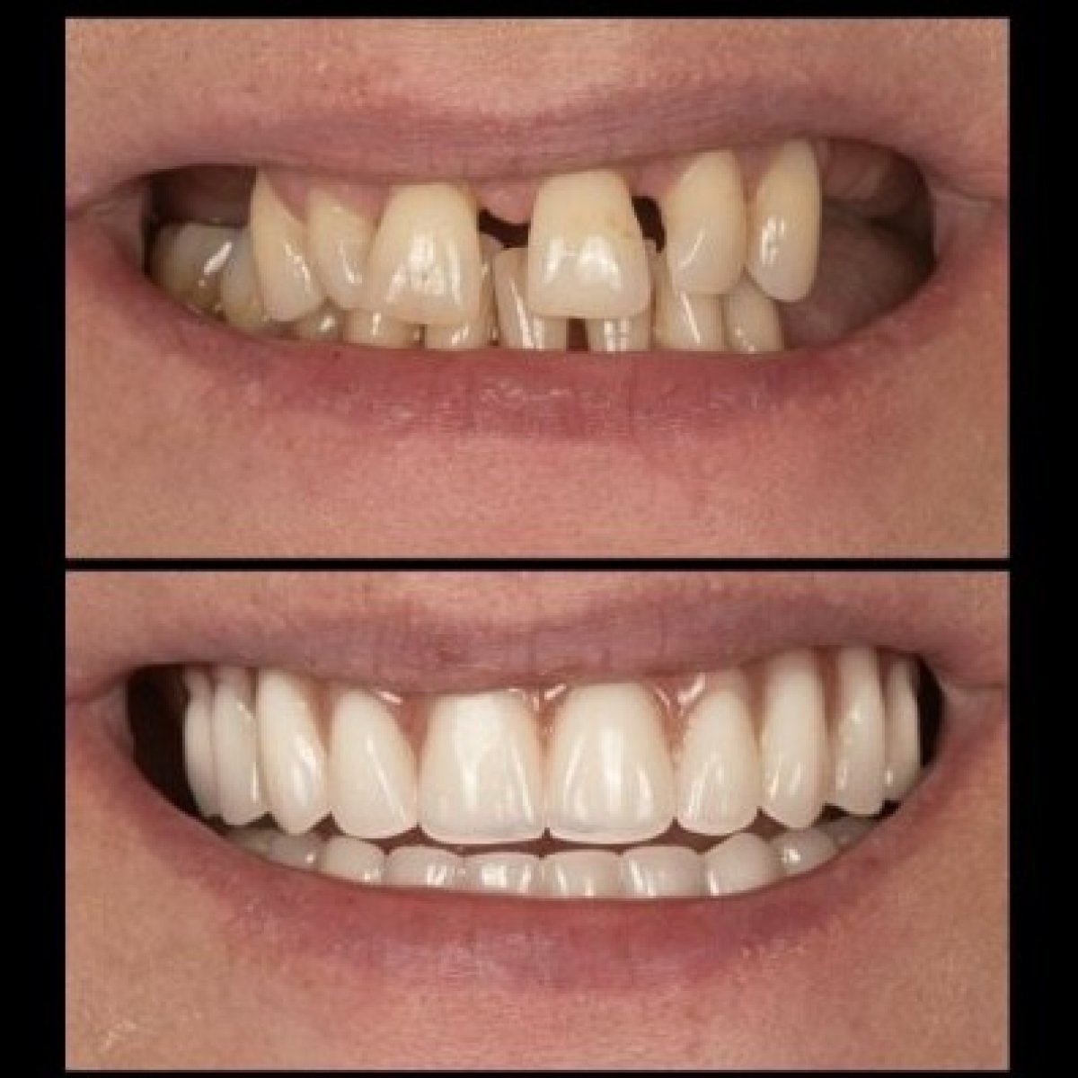 Resultados antes y después de dentadura en HALDENT Dental Clinic – sonrisa y dientes mejorados