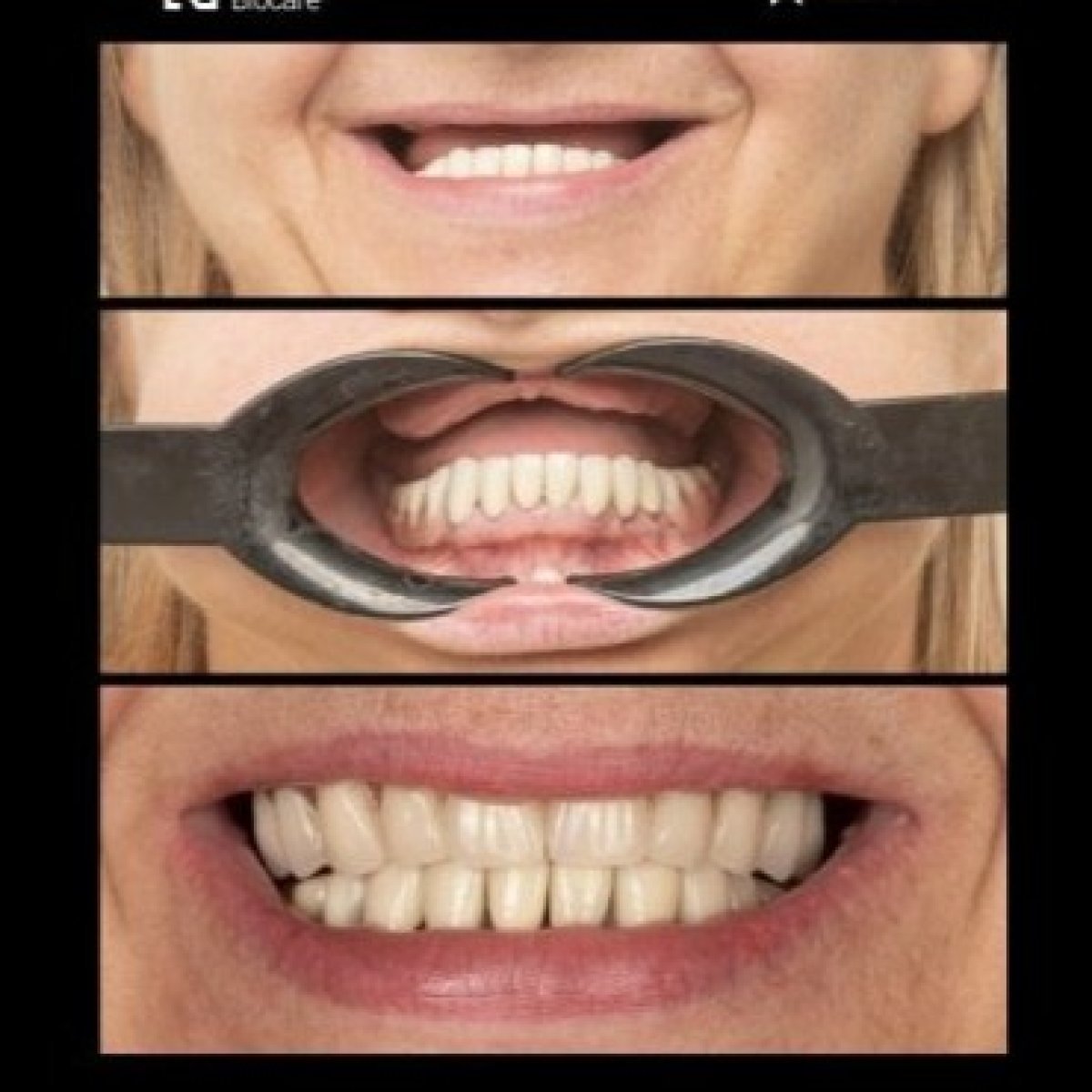 نتائج طقم الأسنان قبل وبعد في HALDENT Dental Clinic – تحسين الابتسامة ومحاذاة الأسنان