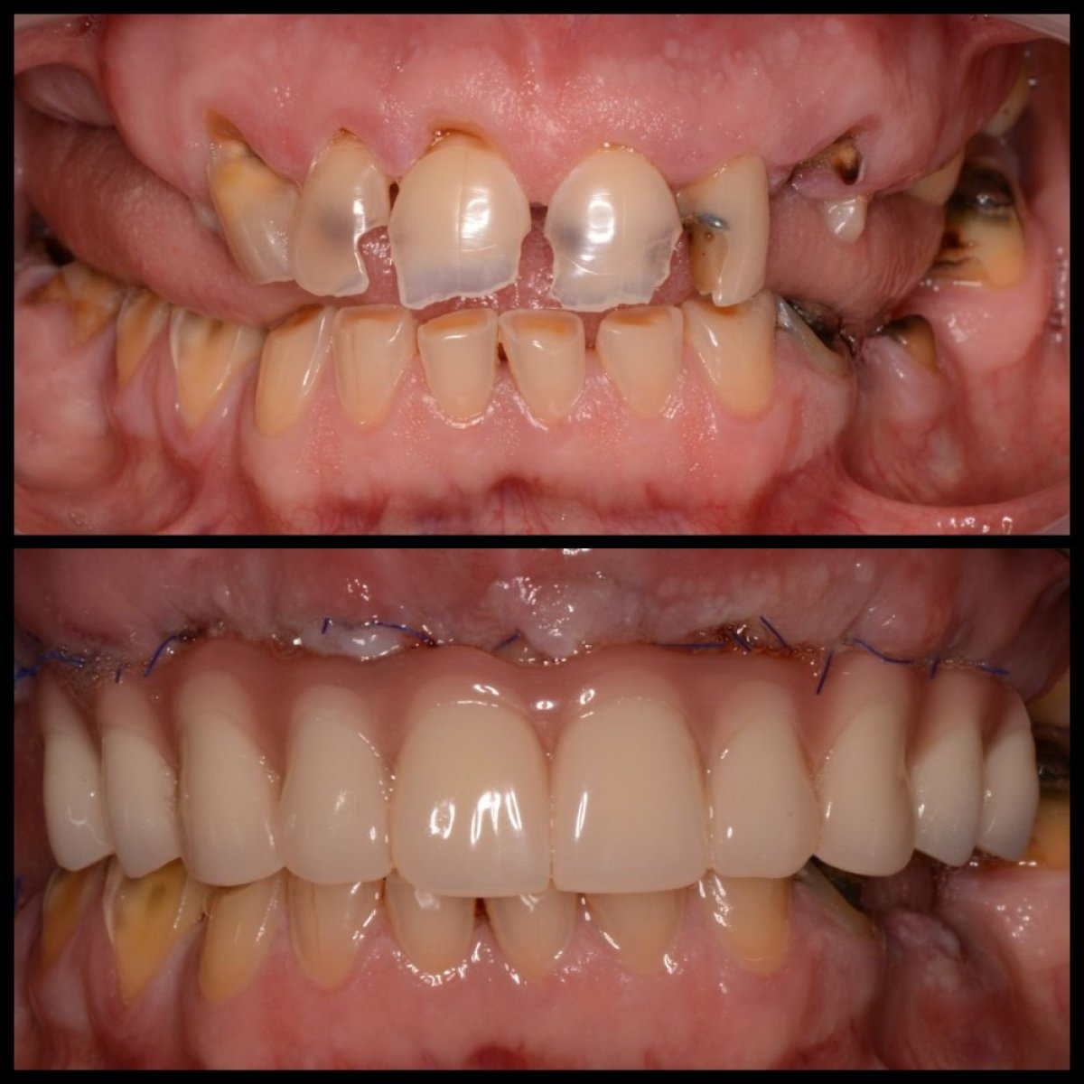 نتائج قبل وبعد تركيب طقم الأسنان في HALDENT Dental Clinic – ابتسامة وأسنان مستعادة