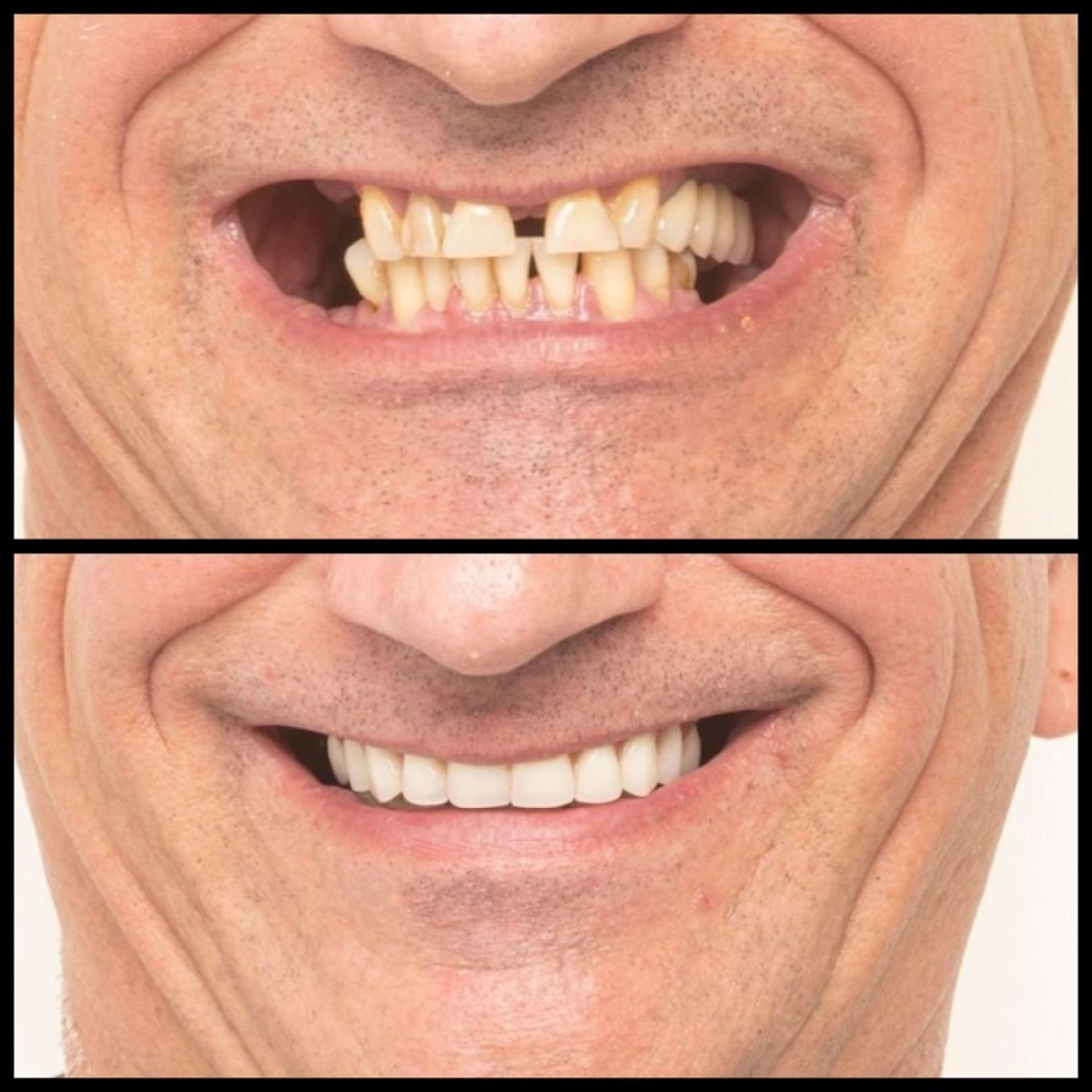 نتائج قبل وبعد طقم الأسنان في HALDENT Dental Clinic – ابتسامة مستعادة
