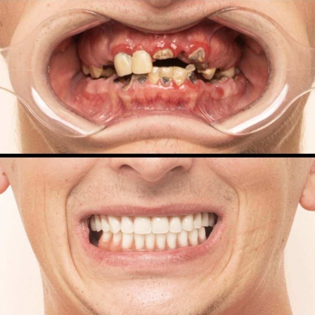 Результати до і після протезування в HALDENT Dental Clinic – повне відновлення усмішки