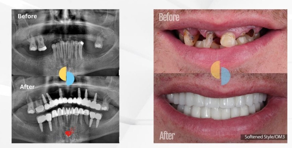 Before and after All-on-4 dental implants results – full mouth restoration and improved smile
