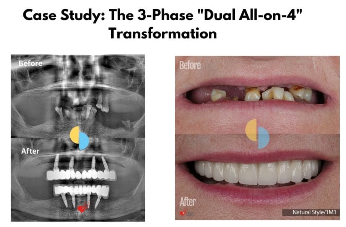 Before and after All-on-4 dental implants results – full mouth restoration and improved smile