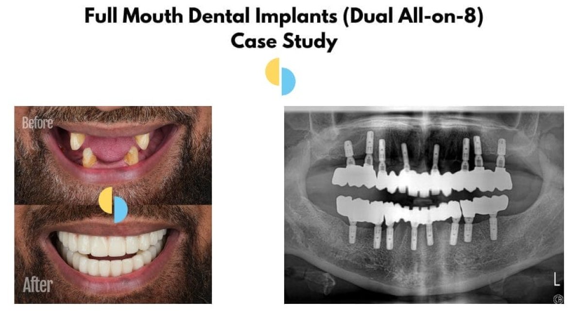 Full mouth dental implants (All-on-8) before and after results with X-ray comparison