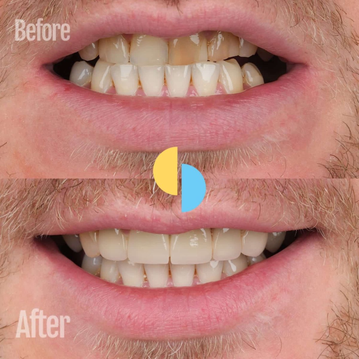 Before and after tooth whitening results – visibly brighter smile after procedure