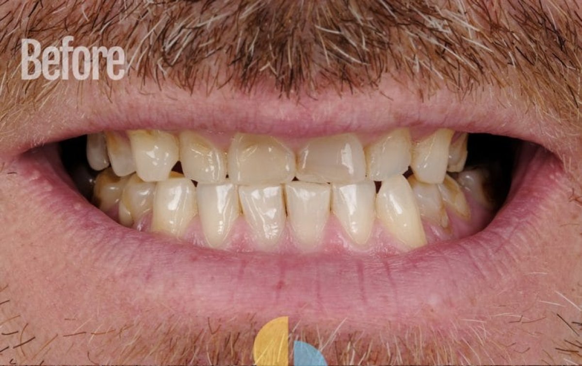 Resultado antes del tratamiento Invisalign, dientes apiñados y desalineados visibles
