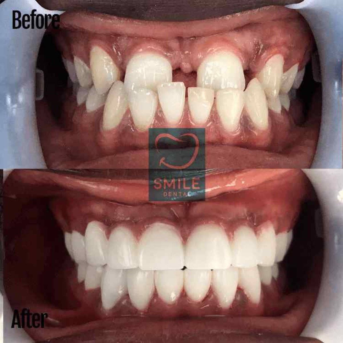 Результаты до и после Invisalign в Smile Dental – ровные зубы и улучшенная улыбка