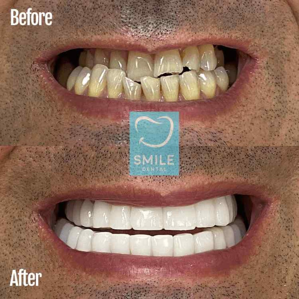 До и после установки виниров в Smile Dental – результат белых ровных зубов