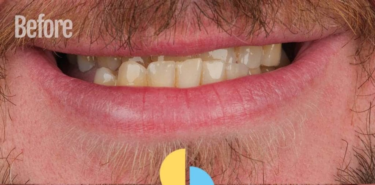 Resultado antes del tratamiento Invisalign, dientes desalineados antes del procedimiento