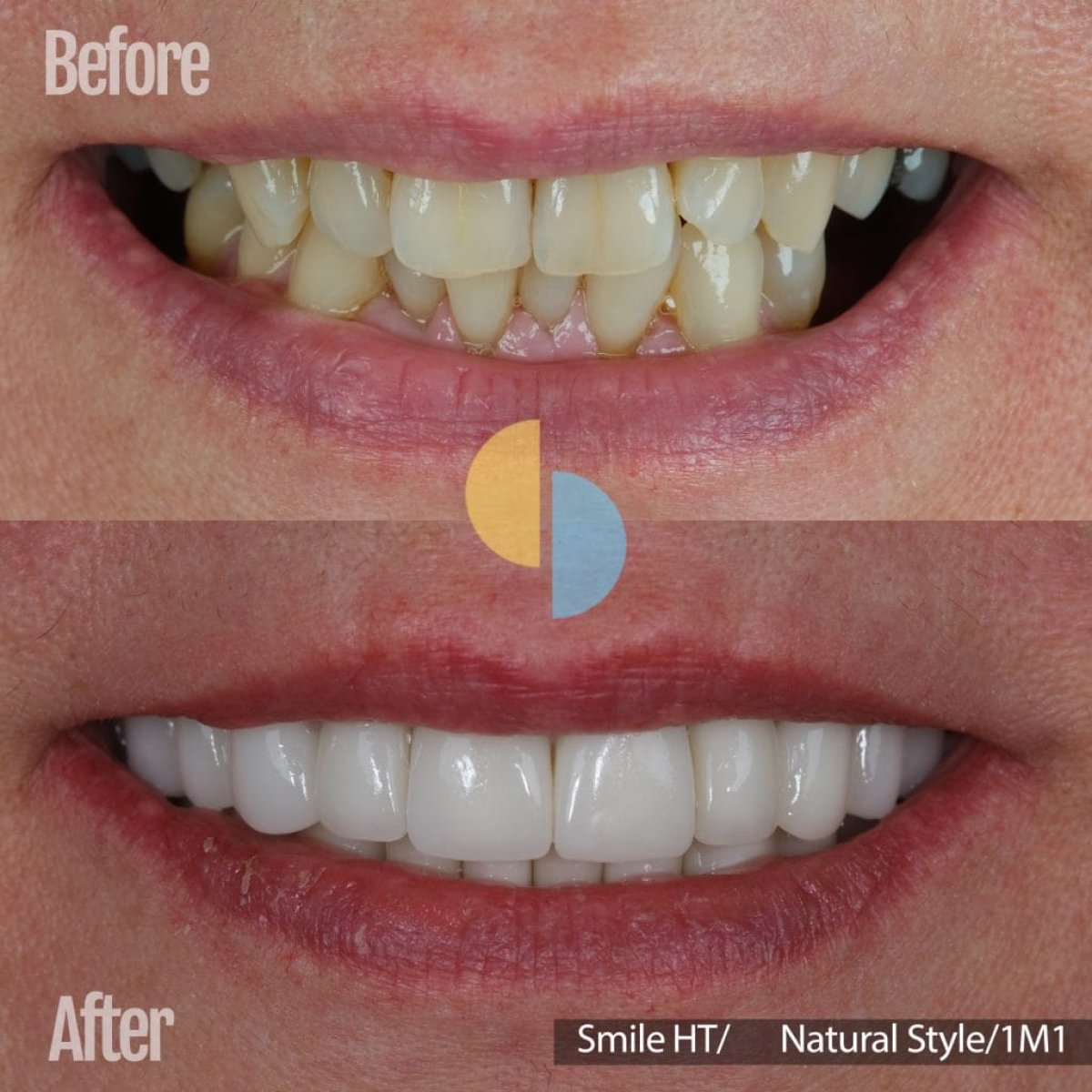 Before and after dental veneers result – whiter, natural-looking smile transformation
