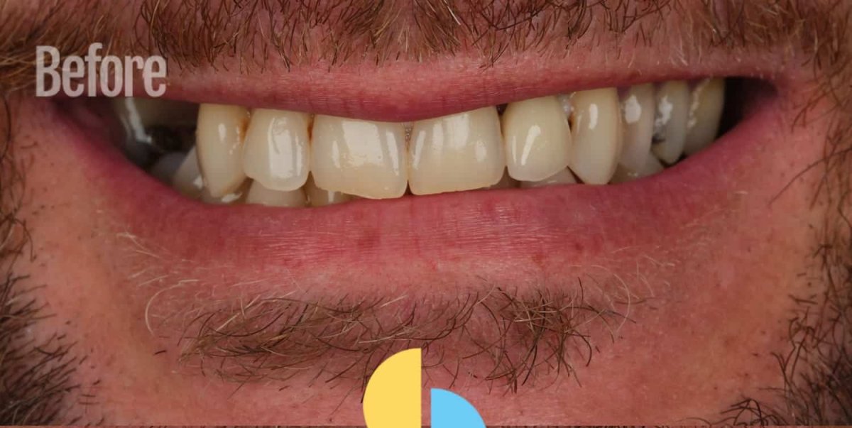Antes del procedimiento de carillas, dientes descoloridos y sonrisa desigual, resultado dental